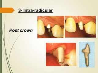3- Intra-radicular
Post crown
 