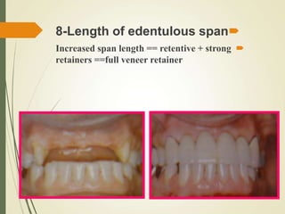 
8-Length of edentulous span

Increased span length == retentive + strong
retainers ==full veneer retainer
 