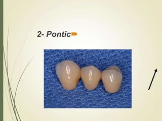 
2- Pontic
 