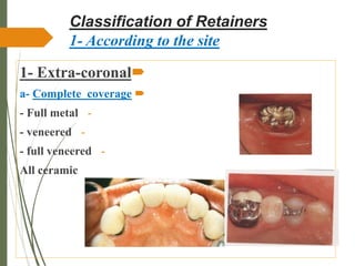 RETAINERS USED FOR FIXED PROSTHODONTICS.ppt