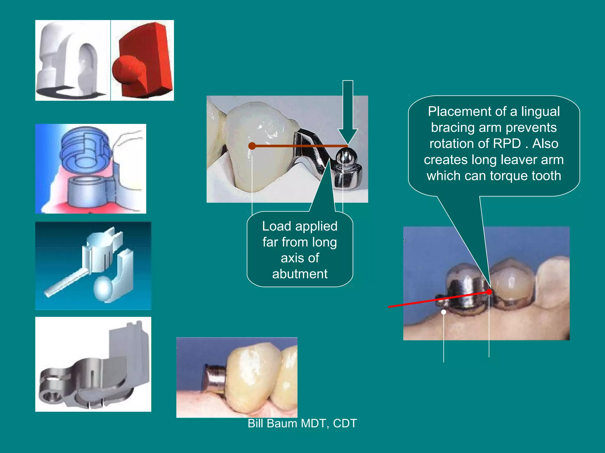 Removable Partial denture Retainer Systems | PPT