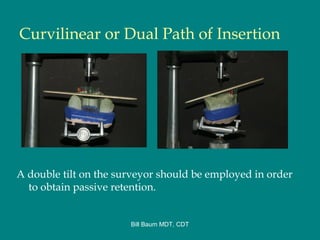 Removable Partial denture Retainer Systems | PPT