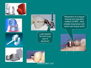 Removable Partial denture Retainer Systems | PPT