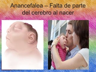 Anancefalea – Falta de parte
del cerebro al nacer

 