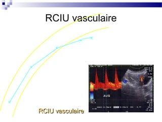RCIU vasculaire
RCIU vasculaireRCIU vasculaire
 