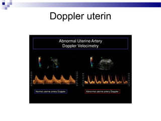 Doppler uterin
 
