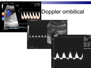 Doppler ombilical
 