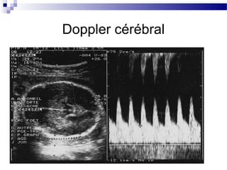 Doppler cérébral
 