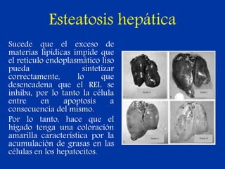 Esteatosis hepática
Sucede que el exceso de
materias lipídicas impide que
el retículo endoplasmático liso
pueda sintetizar
correctamente, lo que
desencadena que el REL se
inhiba, por lo tanto la célula
entre en apoptosis a
consecuencia del mismo.
Por lo tanto, hace que el
hígado tenga una coloración
amarilla característica por la
acumulación de grasas en las
células en los hepatocitos.
 