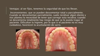 Ventajas: al ser fijos, tenemos la seguridad de que los llevan.
Inconvenientes: que se pueden descementar total o parcialmente.
Cuando se descementan parcialmente, suele recidivar algún diente y
nos plantea la necesidad de tener que corregir esta recidiva; cuando
se descementa totalmente hay riesgo de que se lo pueda tragar el
paciente. Dificultan la higiene, por lo que si el paciente no es muy
cuidadoso, favorecen la acumulación de sarro.
 