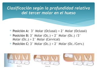 ∗ Posición A: 3° Molar (Oclusal) = 2° Molar (Oclusal)
∗ Posición B: 3° Molar (Oc.) < 2° Molar (Oc.) /3°
Molar (Oc.) > 2° Molar (Cervical)
∗ Posición C: 3° Molar (Oc.) < 2° Molar (Oc./Cerv.)
Clasificación según la profundidad relativa
del tercer molar en el hueso
 
