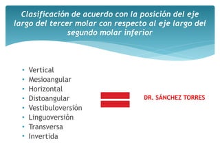 • Vertical
• Mesioangular
• Horizontal
• Distoangular
• Vestibuloversión
• Linguoversión
• Transversa
• Invertida
Clasificación de acuerdo con la posición del eje
largo del tercer molar con respecto al eje largo del
segundo molar inferior
DR. SÁNCHEZ TORRES
 