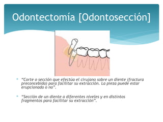 ∗ “Corte o sección que efectúa el cirujano sobre un diente (fractura
preconcebida) para facilitar su extracción. La pieza puede estar
erupcionada o no”.
∗ “Sección de un diente a diferentes niveles y en distintos
fragmentos para facilitar su extracción”.
Odontectomía [Odontosección]
 
