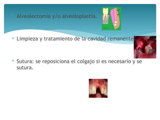 ∗ Alveolectomía y/o alveoloplastía.
∗ Limpieza y tratamiento de la cavidad remanente.
∗ Sutura: se reposiciona el colgajo si es necesario y se
sutura.
 