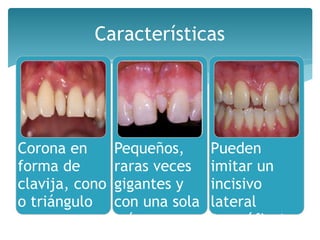 Características
Corona en
forma de
clavija, cono
o triángulo
Pequeños,
raras veces
gigantes y
con una sola
raíz
Pueden
imitar un
incisivo
lateral
(eumófico) o
 
