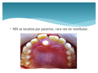 ∗ 90% se localiza por palatino, rara vez en vestibular.
 