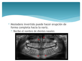 ∗ Mesiodens invertido puede hacer erupción de
forma completa hacia la nariz.
∗ Recibe el nombre de dientes nasales
 