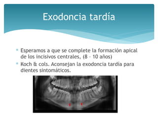 Exodoncia tardía
∗ Esperamos a que se complete la formación apical
de los incisivos centrales, (8 – 10 años)
∗ Koch & cols. Aconsejan la exodoncia tardía para
dientes sintomáticos.
 