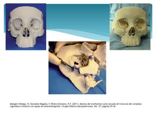 Malagón Hidalgo, H./González Magaña, F./Rivera Estolano, R.T. (2011). Manejo del enoftalmos como secuela de fracturas del complejo
cigomático-orbitario con apoyo de estereolitografía. Cirugía Plástica Iberoamericana, Vol. 37, páginas 35-36
 