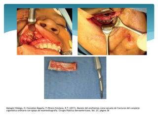 Malagón Hidalgo, H./González Magaña, F./Rivera Estolano, R.T. (2011). Manejo del enoftalmos como secuela de fracturas del complejo
cigomático-orbitario con apoyo de estereolitografía. Cirugía Plástica Iberoamericana, Vol. 37, página 36
 