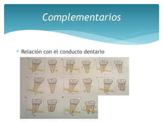 ∗ Relación con el conducto dentario
Complementarios
 