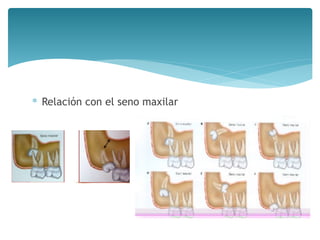 ∗ Relación con el seno maxilar
 