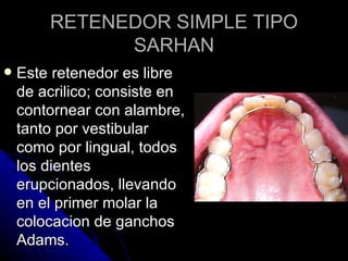 RETENEDOR SIMPLE TIPO SARHAN Este retenedor es libre de acrilico; consiste en contornear con alambre, tanto por vestibular como por lingual, todos los dientes erupcionados, llevando en el primer molar la colocacion de ganchos Adams. 