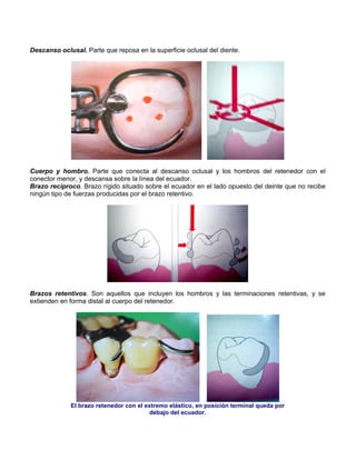 Descanso oclusal. Parte que reposa en la superficie oclusal del diente.
Cuerpo y hombro. Parte que conecta al descanso oclusal y los hombros del retenedor con el
conector menor, y descansa sobre la línea del ecuador.
Brazo recíproco. Brazo rígido situado sobre el ecuador en el lado opuesto del deinte que no recibe
ningún tipo de fuerzas producidas por el brazo retentivo.
Brazos retentivos. Son aquellos que incluyen los hombros y las terminaciones retentivas, y se
extienden en forma distal al cuerpo del retenedor.
El brazo retenedor con el extremo elástico, en posición terminal queda por
debajo del ecuador.
 