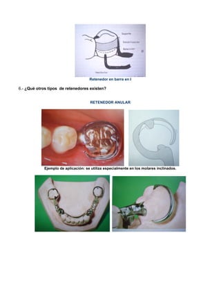 Retenedor en barra en I
6.- ¿Qué otros tipos de retenedores existen?
RETENEDOR ANULAR
Ejemplo de aplicación: se utiliza especialmente en los molares inclinados.
 