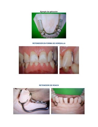 Ejemplo de aplicación
RETENEDOR EN FORMA DE HORQUILLA
RETENEDOR DE ROACH
 