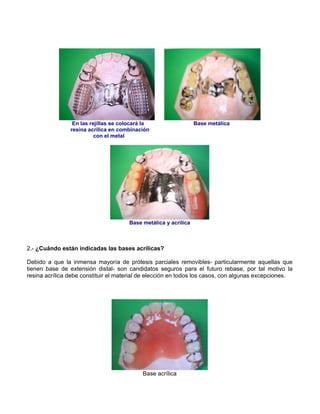 En las rejillas se colocará la Base metálica
resina acrílica en combinación
con el metal
Base metálica y acrílica
2.- ¿Cuándo están indicadas las bases acrílicas?
Debido a que la inmensa mayoría de prótesis parciales removibles- particularmente aquellas que
tienen base de extensión distal- son candidatos seguros para el futuro rebase, por tal motivo la
resina acrílica debe constituir el material de elección en todos los casos, con algunas excepciones.
Base acrílica
 