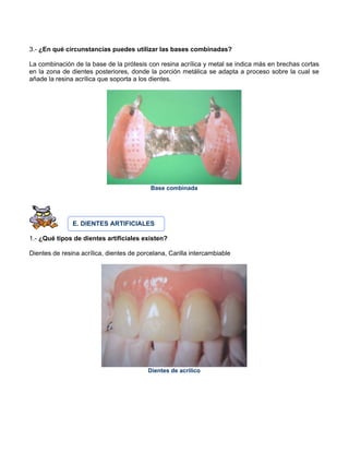 3.- ¿En qué circunstancias puedes utilizar las bases combinadas?
La combinación de la base de la prótesis con resina acrílica y metal se indica más en brechas cortas
en la zona de dientes posteriores, donde la porción metálica se adapta a proceso sobre la cual se
añade la resina acrílica que soporta a los dientes.
Base combinada
E. DIENTES ARTIFICIALES
1.- ¿Qué tipos de dientes artificiales existen?
Dientes de resina acrílica, dientes de porcelana, Carilla intercambiable
Dientes de acrílico
 