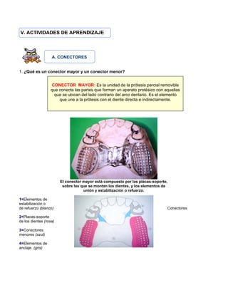 V. ACTIVIDADES DE APRENDIZAJE
A. CONECTORES
1. ¿Qué es un conector mayor y un conector menor?
El conector mayor está compuesto por las placas-soporte,
sobre las que se montan los dientes, y los elementos de
unión y estabilización o refuerzo.
1=Elementos de
estabilización o
de refuerzo (blanco) Conectores
2=Placas-soporte
de los dientes (rosa)
3=Conectores
menores (azul)
4=Elementos de
anclaje. (gris)
CONECTOR MAYOR: Es la unidad de la prótesis parcial removible
que conecta las partes que forman un aparato protésico con aquellas
que se ubican del lado contrario del arco dentario. Es el elemento
que une a la prótesis con el diente directa e indirectamente.
 