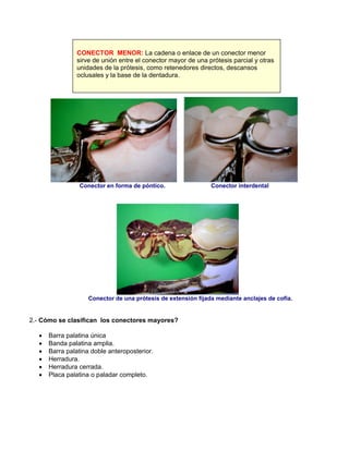 Conector en forma de póntico. Conector interdental
Conector de una prótesis de extensión fijada mediante anclajes de cofia.
2.- Cómo se clasifican los conectores mayores?
• Barra palatina única
• Banda palatina amplia.
• Barra palatina doble anteroposterior.
• Herradura.
• Herradura cerrada.
• Placa palatina o paladar completo.
CONECTOR MENOR: La cadena o enlace de un conector menor
sirve de unión entre el conector mayor de una prótesis parcial y otras
unidades de la prótesis, como retenedores directos, descansos
oclusales y la base de la dentadura.
 