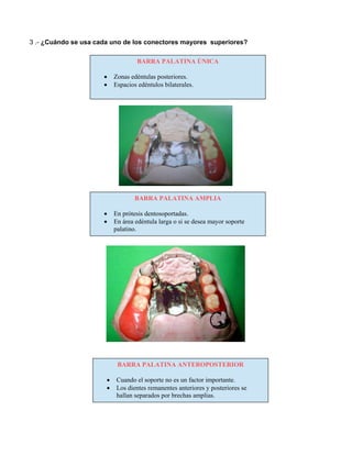 3 .- ¿Cuándo se usa cada uno de los conectores mayores superiores?
BARRA PALATINA ÚNICA
• Zonas edéntulas posteriores.
• Espacios edéntulos bilaterales.
BARRA PALATINA AMPLIA
• En prótesis dentosoportadas.
• En área edéntula larga o si se desea mayor soporte
palatino.
BARRA PALATINA ANTEROPOSTERIOR
• Cuando el soporte no es un factor importante.
• Los dientes remanentes anteriores y posteriores se
hallan separados por brechas amplias.
 
