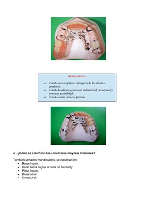 4.- ¿Cómo se clasifican los conectores mayores inferiores?
También llamados mandibulares, se clasifican en:
• Barra lingual.
• Doble barra lingual o barra de Kennedy.
• Placa lingual.
• Barra labial.
• Swing Lock
HERRADURA
• Cuando se reemplacen la mayoría de los dientes
anteriores.
• Cuando los dientes presentan enfermedad periodontal y
necesitan estabilidad.
• Cuando existe un torus palatino.
 