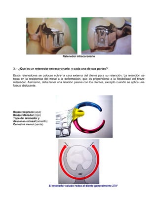 Retenedor intracoronario
3.- ¿Qué es un retenedor extracoronario y cada una de sus partes?
Estos retenedores se colocan sobre la cara externa del diente para su retención. La retención se
basa en la resistencia del metal a la deformación, que es proporcional a la flexibilidad del brazo
retenedor. Asimismo, debe tener una relación pasiva con los dientes, excepto cuando se aplica una
fuerza dislocante.
Brazo recíproco (azul)
Brazo retenedor (rojo)
Tope del retenedor y
descanso oclusal (amarillo)
Conector menor (verde)
El retenedor colado rodea al diente generalmente 270°
 