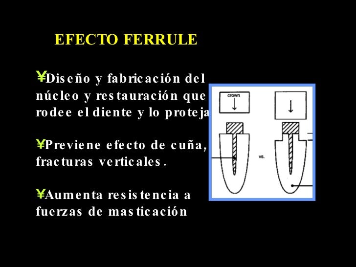 Retenedores Intraradiculares 2