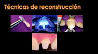 TitanioFlexuralproperties of endodonticposts andhumanrootdentinResultadosLa resistencia a la flexión de la dentina es 212.9 Mps