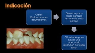 Villafana  C et al. Resistance to the fracture of dental pieces recovered with anchorages of carbon fiber and strained - study in vitro. http://www.revistavisiondental.net/articulo_01.htm