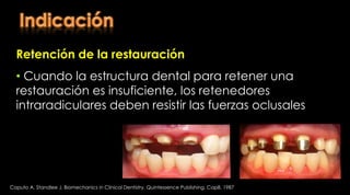 Kantor, M., Pines, M. A comparative study of restorative techniques for pulpless teeth. J. Prost. Dent. (1977) 38:405Consideraciones delos dientes tratados con endodonciaRestauración de un diente tratado endodónticamenteAntes de realizar el tratamiento de endodoncia se debe evaluar la cantidad de tejido dentario remanente que quedará después de la preparación endodóntica