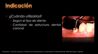 Restauración de un diente tratado endodónticamente