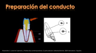 Resistencia a la fractura de raíces debilitadas restauradas con un poste transparente y materiales restaurativos adhesivos El aumento en el espesor de la pared de raíces debilitadas con resinas compuestas puede aumentar  la resistencia de la raíz a la fracturaAlmeida L et al. Fracture resistance of weakenedrootsrestoredwith a transilluminating post and adhesiverestorativematerials. J ProsthetDent2006;96:339-44