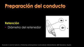 Resistencia a la fractura de raíces debilitadas restauradas con un poste transparente y materiales restaurativos adesivosEl propósito de este estudio fue determinar la resistencia a la fractura de raíces experimentalmente debilitadas y reforzadas con  resinas compuestas, comparadas con sistemas convencionales que usan los postes prefebricadosAlmeida L et al. Fracture resistance of weakenedrootsrestoredwith a transilluminating post and adhesiverestorativematerials. J ProsthetDent2006;96:339-44