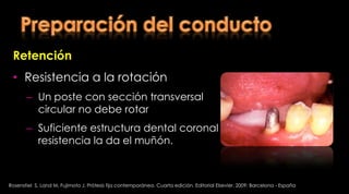 Preparación del conductoRosenstiel  S, Land M, Fujimoto J. Prótesis fija contemporánea. Cuarta edición. Editorial Elsevier. 2009; Barcelona - España