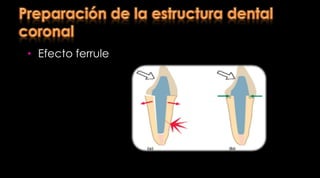 Preparación del conductoRetención Agente de unión (Cementante)Han evolucionado considerablemente durante los últimos añosLa posibilidad de adhesión a la dentina ha incrementado las opcionesEl uso de  cementos que se adhieren a la estructura dental y al material del núcleo producen considerables ventajasRosenstiel  S, Land M, Fujimoto J. Prótesis fija contemporánea. Cuarta edición. Editorial Elsevier. 2009; Barcelona - España