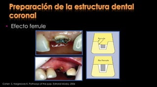 Preparación del conductoRetención Distribución de tensiónUna de las funciones de un muñón colado es mejorar la resistencia a las fuerzas dirigidas lateralmente distribuyéndolas sobre un área del mayor tamaño posibleEl diseño del poste debe distribuir las tensiones lo más uniforme posibleRosenstiel  S, Land M, Fujimoto J. Prótesis fija contemporánea. Cuarta edición. Editorial Elsevier. 2009; Barcelona - España