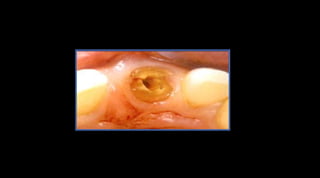 Preparación del conductoRetención Las mayores concentraciones de tensión se encuentran en el hombro y apical (conservar la mayor cantidad de dentina posible)Rosenstiel  S, Land M, Fujimoto J. Prótesis fija contemporánea. Cuarta edición. Editorial Elsevier. 2009; Barcelona - España