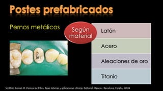 Influencia de la longitud del poste y la longitud del ferrule en la resistencia a la carga cíclica en dientes bovinos con postes prefabricados de titanioEn el modelo utilizado, una longitud media de poste (7.5mm), mostró menos resistencia a la carga cíclica que un poste corto  de 5mm, o largo  de 10mm