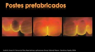 RI colados – ProcedimientoTécnica directaTécnica indirectaRosenstiel  S, Land M, Fujimoto J. Prótesis fija contemporánea. Cuarta edición. Editorial Elsevier. 2009; Barcelona - España